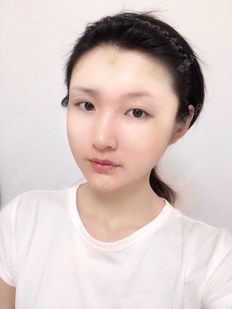 更美 - 惜你若命_x的假体垫苹果肌经验 | 假体垫苹果肌 | 北京