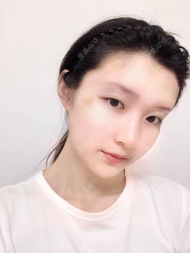 更美 - 惜你若命_x的假体垫苹果肌经验 | 假体垫苹果肌 | 北京