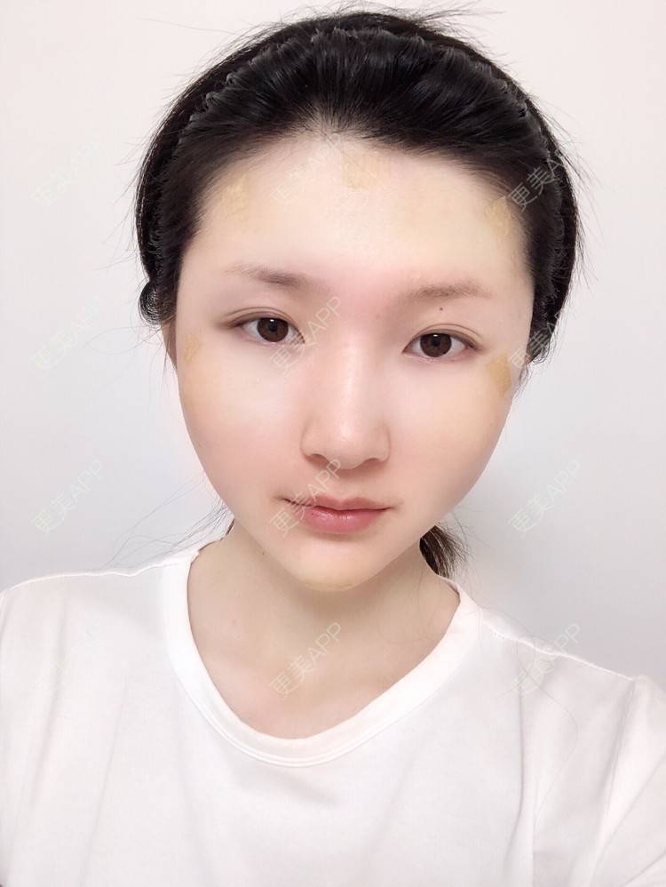 更美 - 惜你若命_x的假体垫苹果肌经验 | 假体垫苹果肌 | 北京