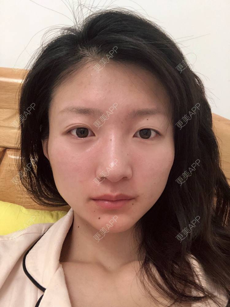 更美 - 惜你若命_x的假体垫苹果肌经验 | 假体垫苹果肌 | 北京