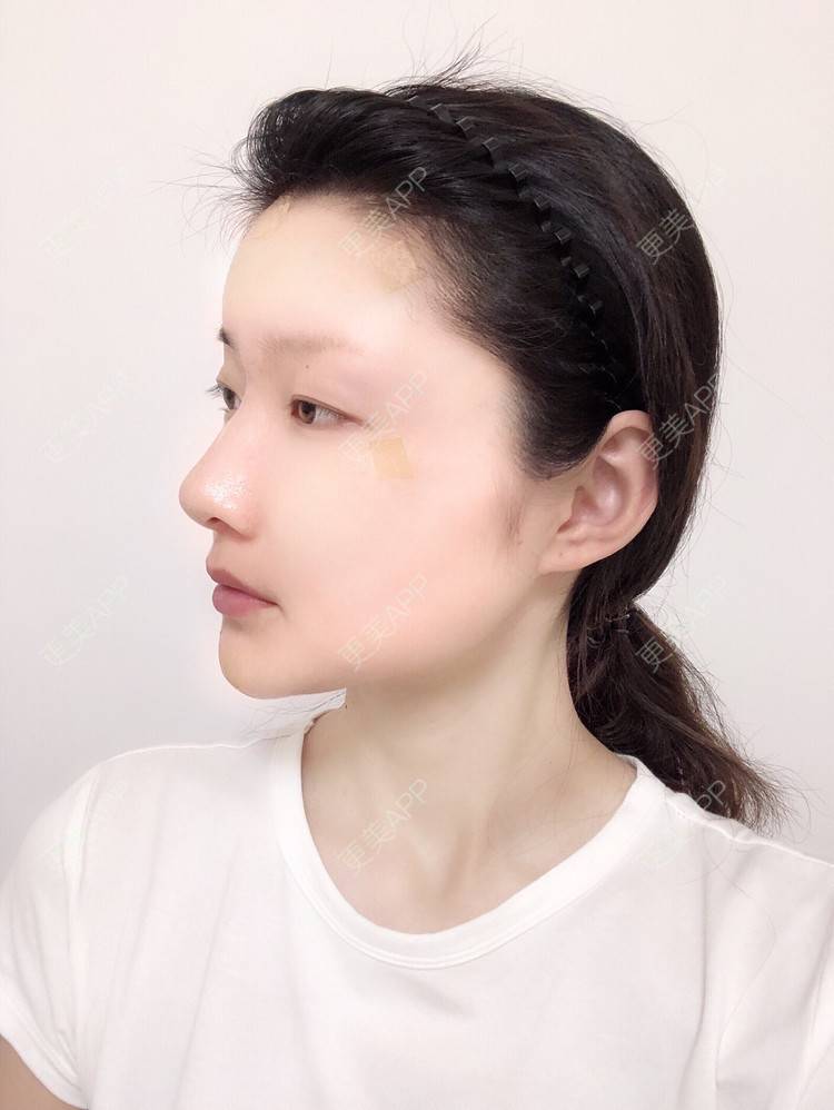 更美 - 惜你若命_x的假体垫苹果肌经验 | 假体垫苹果肌 | 北京
