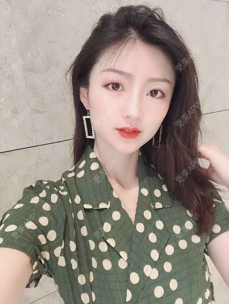 更美 - 惜你若命_x的假体垫苹果肌经验 | 假体垫苹果肌 | 北京
