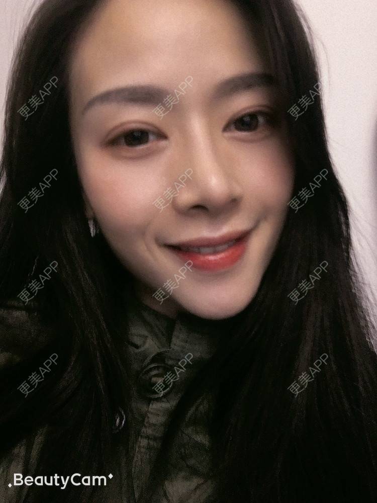更美 - 进击的露露的隆鼻经验 | 隆鼻 | 鼻部多项 | 硅胶垫下巴 | 膨体隆鼻 | 重庆 | 鼻中隔软骨隆鼻 | 耳软骨隆鼻