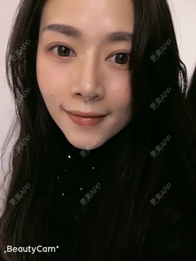 更美 - 进击的露露的隆鼻经验 | 隆鼻 | 鼻部多项 | 硅胶垫下巴 | 膨体隆鼻 | 重庆 | 鼻中隔软骨隆鼻 | 耳软骨隆鼻