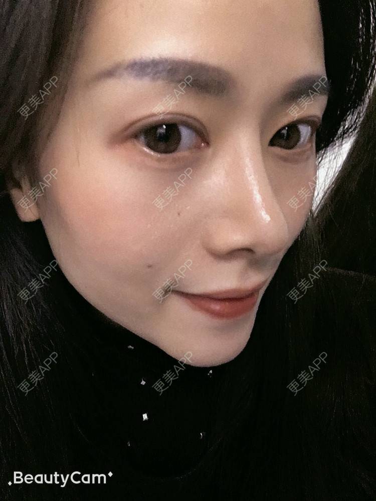 更美 - 进击的露露的隆鼻经验 | 隆鼻 | 鼻部多项 | 硅胶垫下巴 | 膨体隆鼻 | 重庆 | 鼻中隔软骨隆鼻 | 耳软骨隆鼻