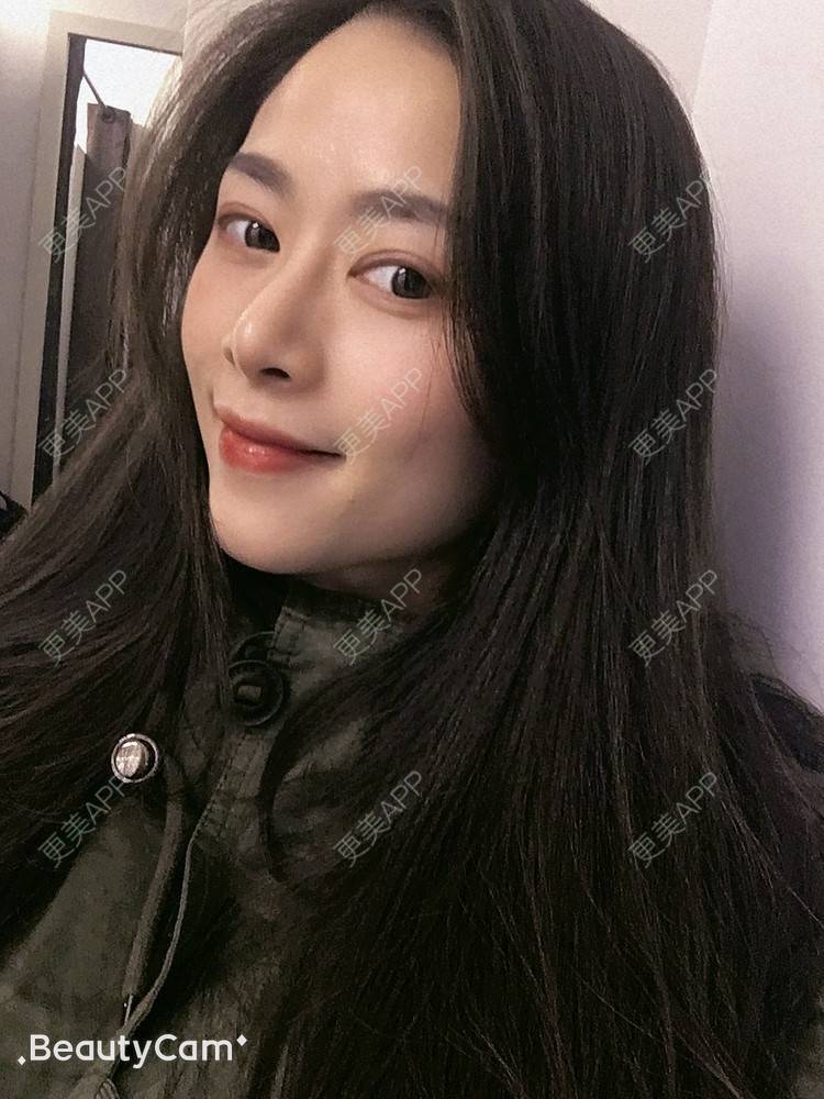 更美 - 进击的露露的隆鼻经验 | 隆鼻 | 鼻部多项 | 硅胶垫下巴 | 膨体隆鼻 | 重庆 | 鼻中隔软骨隆鼻 | 耳软骨隆鼻