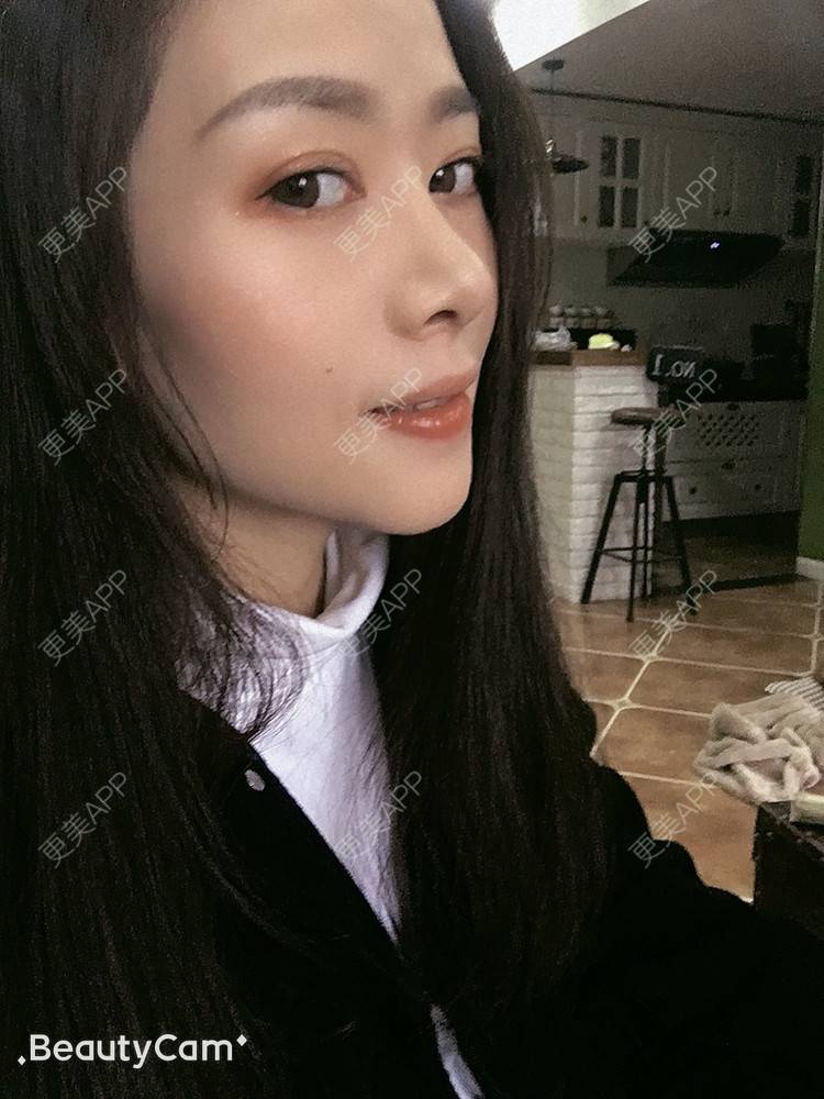 更美 - 进击的露露的隆鼻经验 | 隆鼻 | 鼻部多项 | 硅胶垫下巴 | 膨体隆鼻 | 重庆 | 鼻中隔软骨隆鼻 | 耳软骨隆鼻