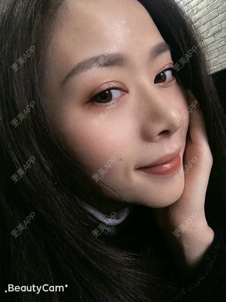更美 - 进击的露露的隆鼻经验 | 隆鼻 | 鼻部多项 | 硅胶垫下巴 | 膨体隆鼻 | 重庆 | 鼻中隔软骨隆鼻 | 耳软骨隆鼻