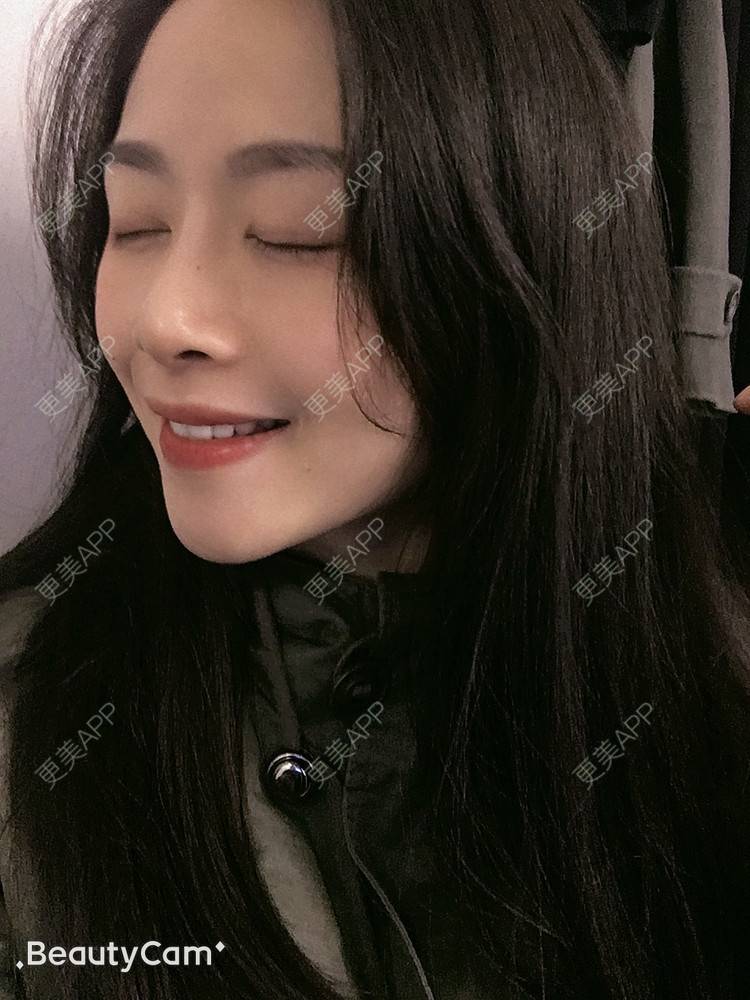 更美 - 进击的露露的隆鼻经验 | 隆鼻 | 鼻部多项 | 硅胶垫下巴 | 膨体隆鼻 | 重庆 | 鼻中隔软骨隆鼻 | 耳软骨隆鼻