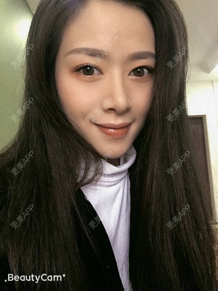 更美 - 进击的露露的隆鼻经验 | 隆鼻 | 鼻部多项 | 硅胶垫下巴 | 膨体隆鼻 | 重庆 | 鼻中隔软骨隆鼻 | 耳软骨隆鼻