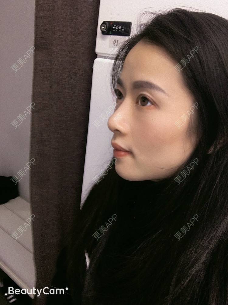 更美 - 进击的露露的隆鼻经验 | 隆鼻 | 鼻部多项 | 硅胶垫下巴 | 膨体隆鼻 | 重庆 | 鼻中隔软骨隆鼻 | 耳软骨隆鼻