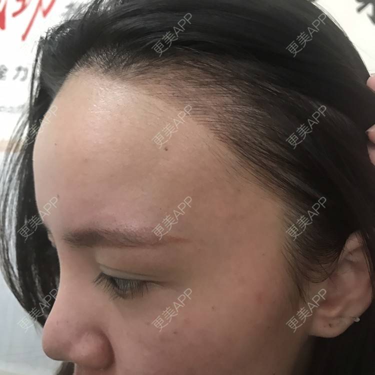更美 - 更美用户4Hyjx7UQA2的半永久纹发际线经验 | 惠州 | 半永久纹发际线