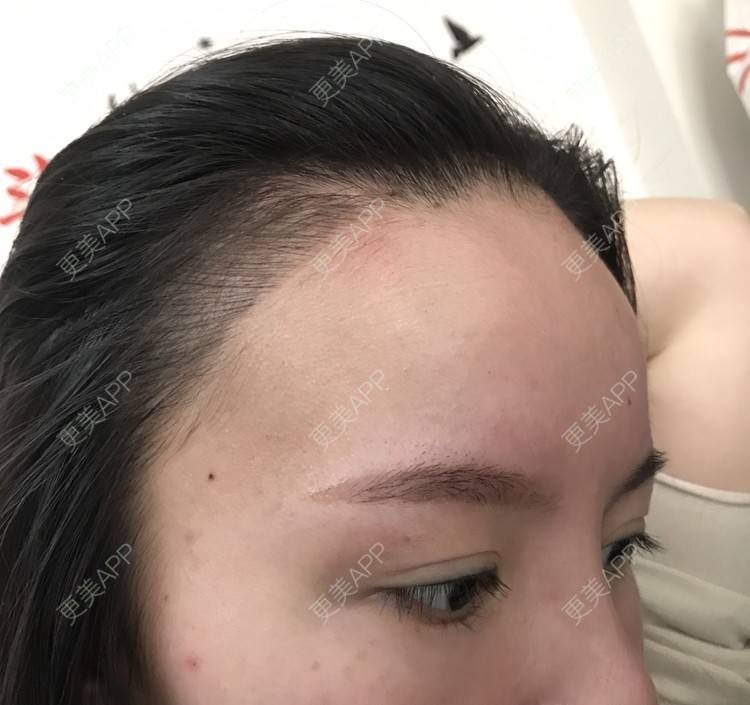 更美 - 更美用户4Hyjx7UQA2的半永久纹发际线经验 | 惠州 | 半永久纹发际线