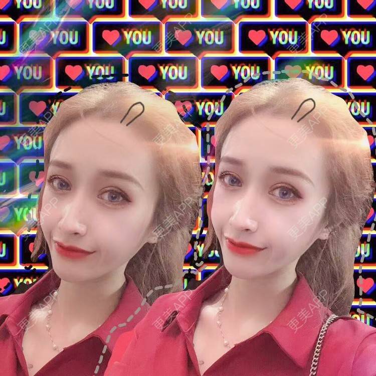 更美 - 丢了灵魂的孩纸的唇腭裂修复经验 | 厚唇改薄 | 唇腭裂修复 | 玻尿酸唇部 | 自体脂肪丰唇 | 胶原蛋白丰唇