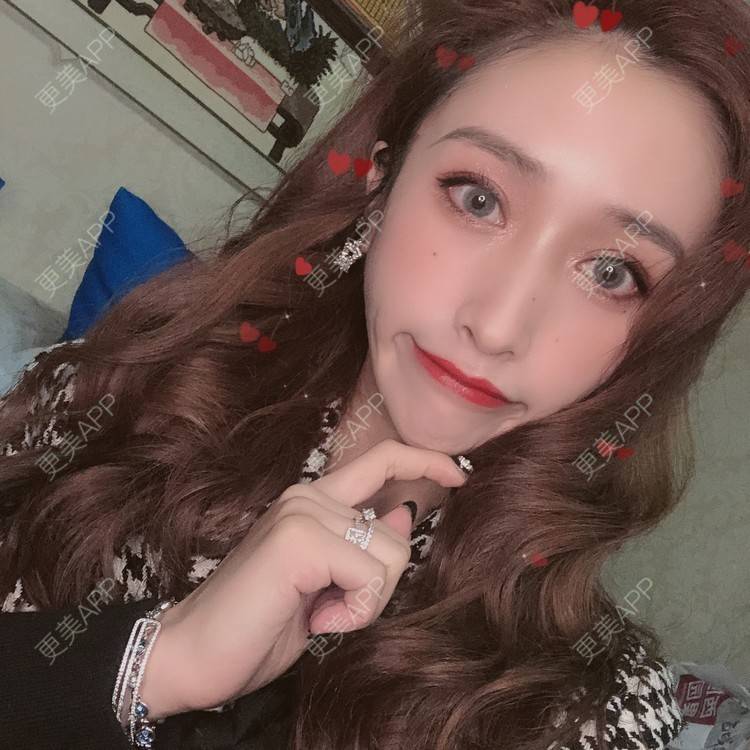 更美 - 丢了灵魂的孩纸的唇腭裂修复经验 | 厚唇改薄 | 唇腭裂修复 | 玻尿酸唇部 | 自体脂肪丰唇 | 胶原蛋白丰唇