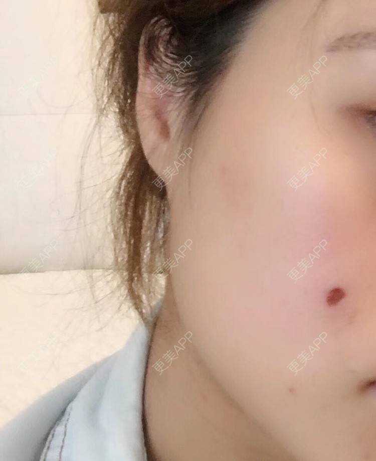更美 - 更美用户Fbey21Pntj的激光淡疤经验 | 激光淡疤