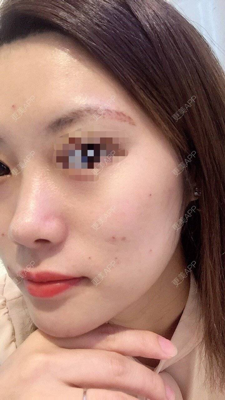 更美 - 更美用户Fbey21Pntj的激光淡疤经验 | 激光淡疤