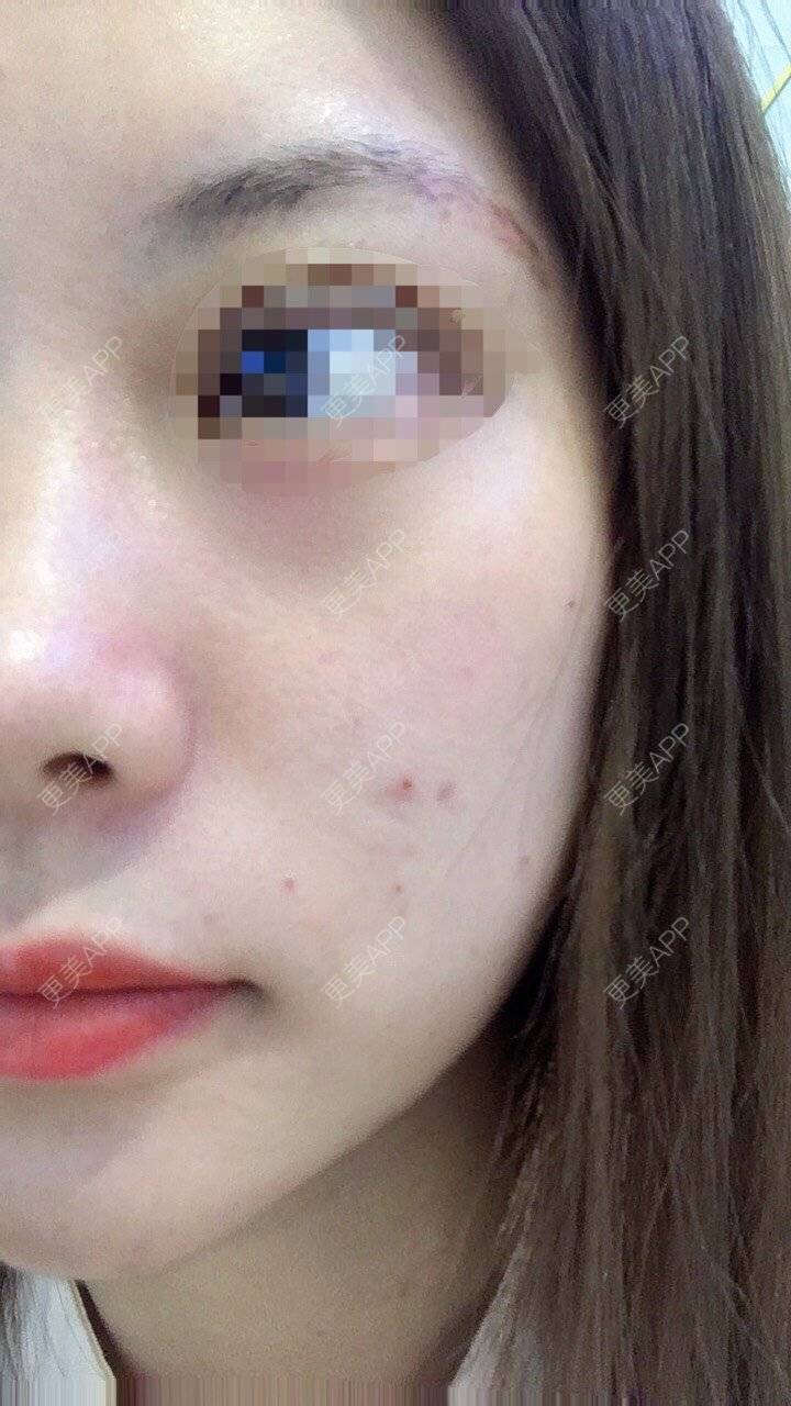 更美 - 更美用户Fbey21Pntj的激光淡疤经验 | 激光淡疤