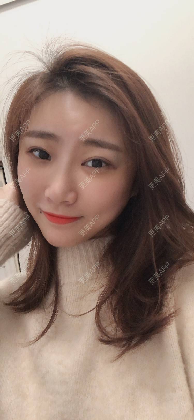 更美 - 更美用户IghjRWworf的自体脂肪填充颈纹经验 | 自体脂肪填充颈纹 | 重庆