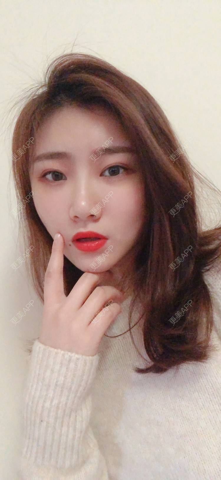 更美 - 更美用户IghjRWworf的自体脂肪填充颈纹经验 | 自体脂肪填充颈纹 | 重庆