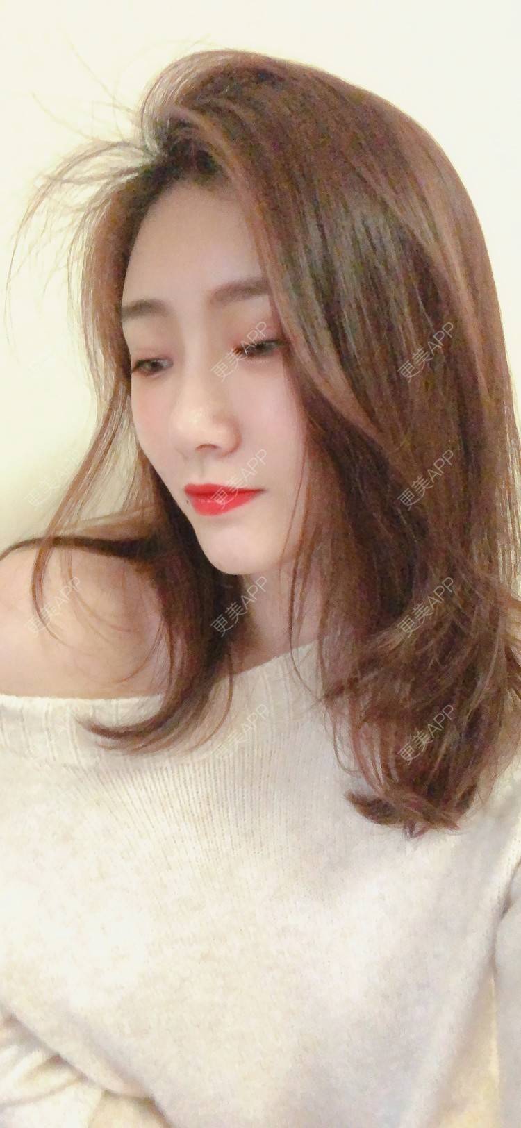 更美 - 更美用户IghjRWworf的自体脂肪填充颈纹经验 | 自体脂肪填充颈纹 | 重庆