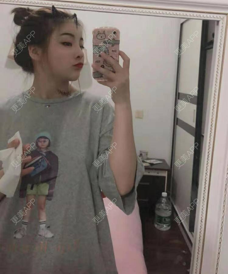 更美 - 静静j的自体脂肪丰额头经验 | 上海 | 自体脂肪丰额头