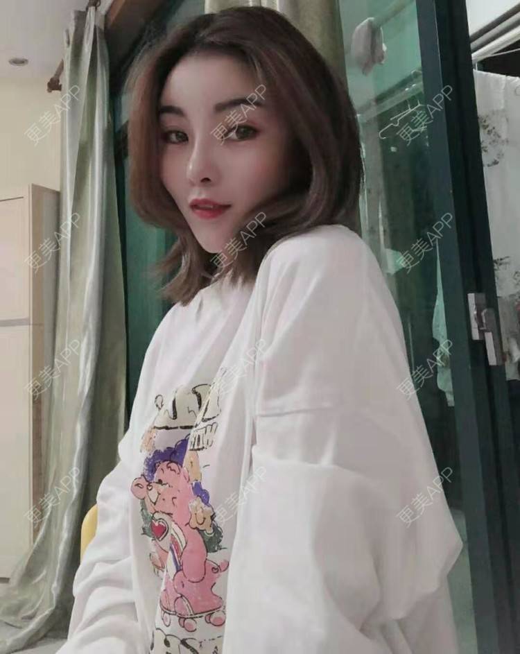 更美 - 静静j的自体脂肪丰额头经验 | 上海 | 自体脂肪丰额头