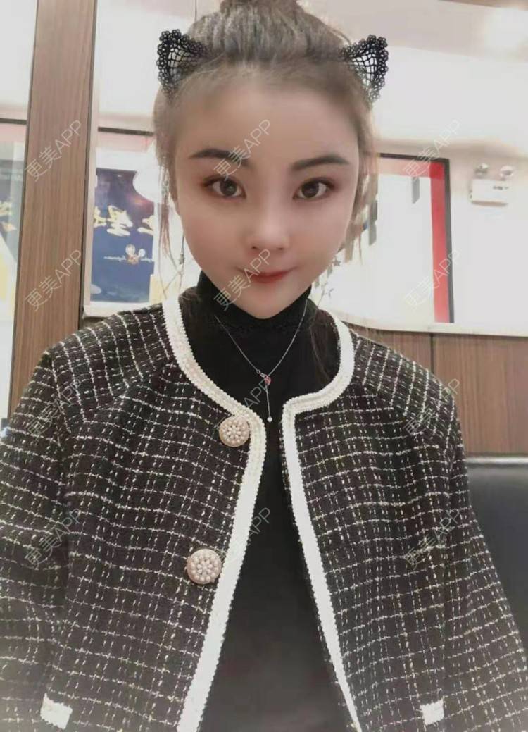 更美 - 静静j的自体脂肪丰额头经验 | 上海 | 自体脂肪丰额头