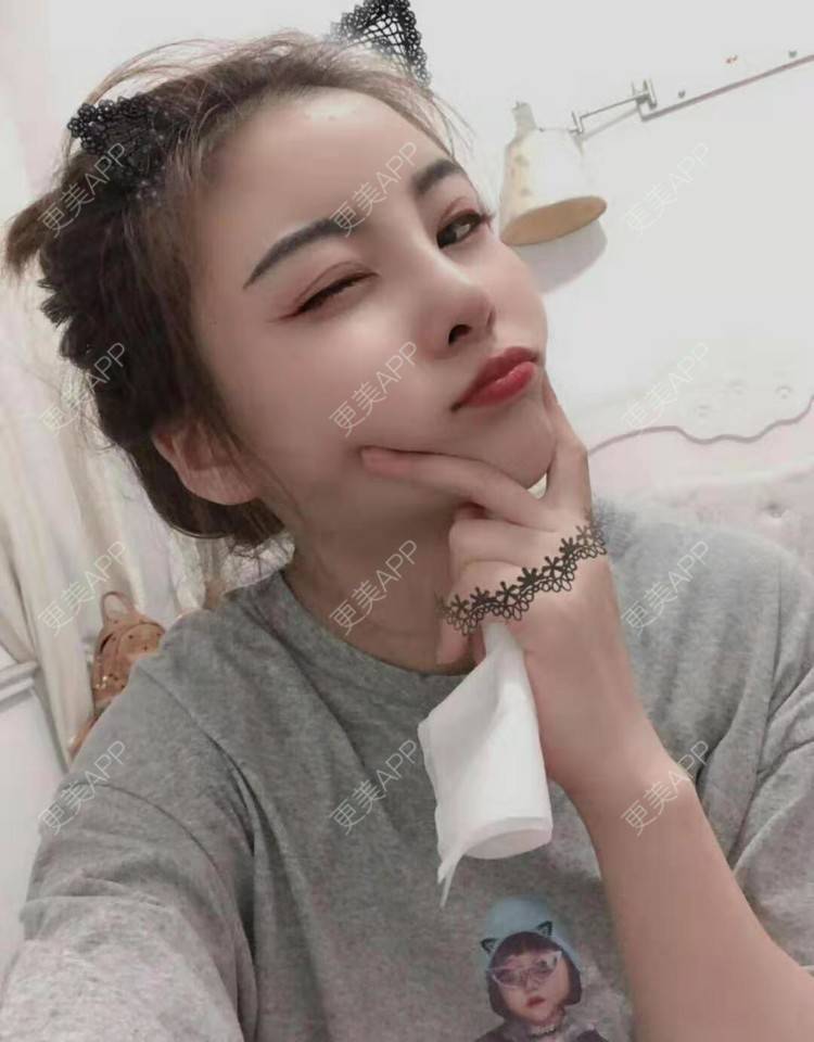 更美 - 静静j的自体脂肪丰额头经验 | 上海 | 自体脂肪丰额头