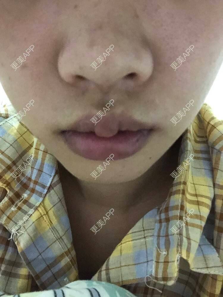 更美 - 小菲菲1992的M唇成形经验 | 武汉 | M唇成形