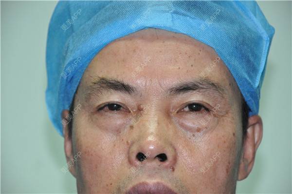 更美 - 更美用户IG0lQLfUjW的外切去眼袋经验 | 杭州 | 外切去眼袋