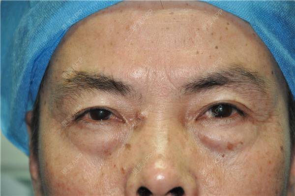 更美 - 更美用户IG0lQLfUjW的外切去眼袋经验 | 杭州 | 外切去眼袋