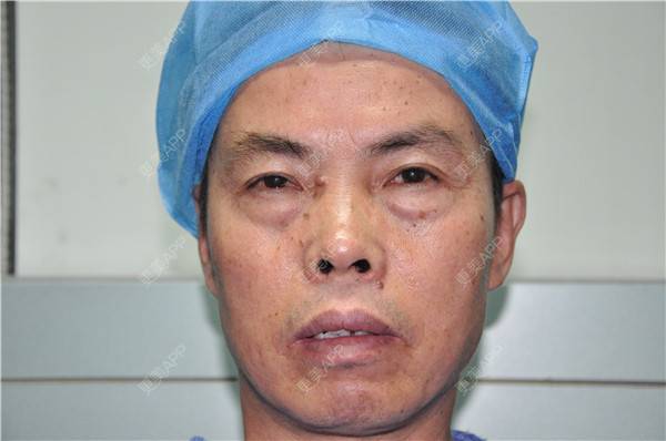 更美 - 更美用户IG0lQLfUjW的外切去眼袋经验 | 杭州 | 外切去眼袋