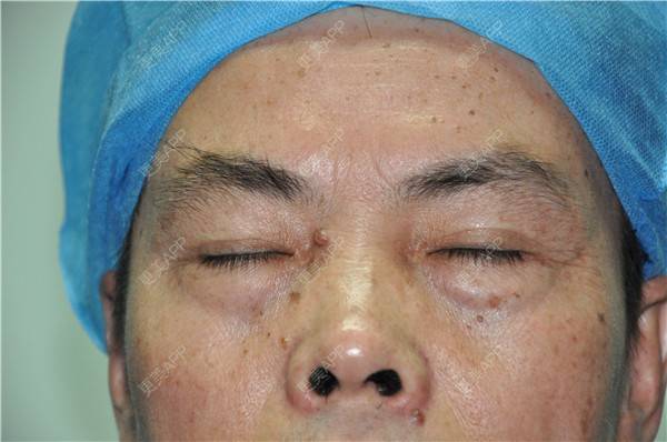 更美 - 更美用户IG0lQLfUjW的外切去眼袋经验 | 杭州 | 外切去眼袋