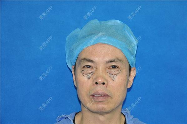 更美 - 更美用户IG0lQLfUjW的外切去眼袋经验 | 杭州 | 外切去眼袋