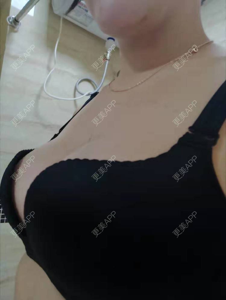 更美 - 辣辣的辣辣的假体隆胸经验 | 更美研究所 | 丰胸（隆胸） | 杭州 | 假体隆胸