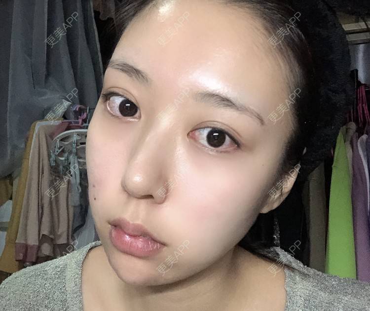 更美 - 薄情人゜缓的M唇成形经验 | M唇成形 | 武汉