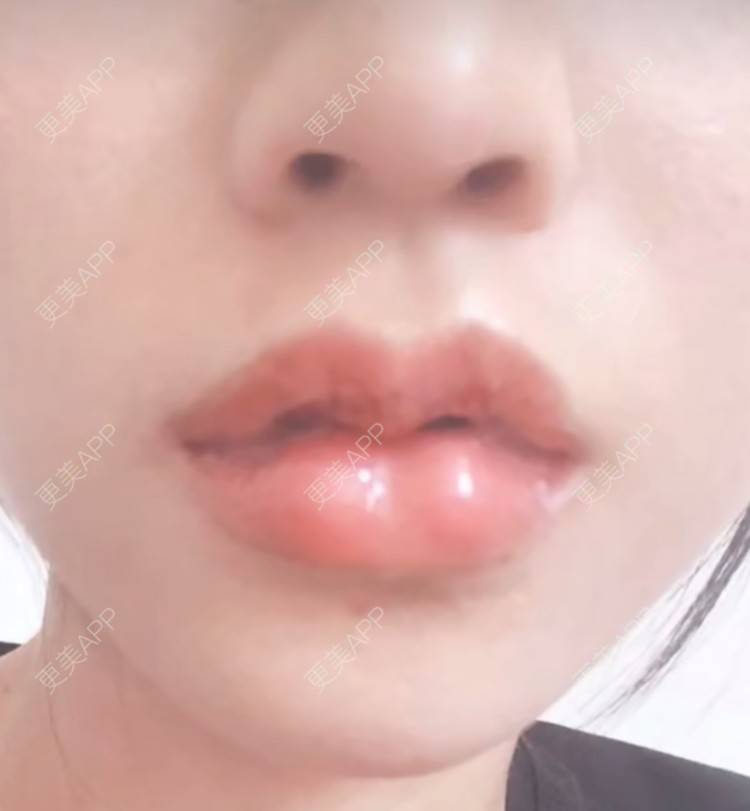 更美 - 薄情人゜缓的M唇成形经验 | M唇成形 | 武汉