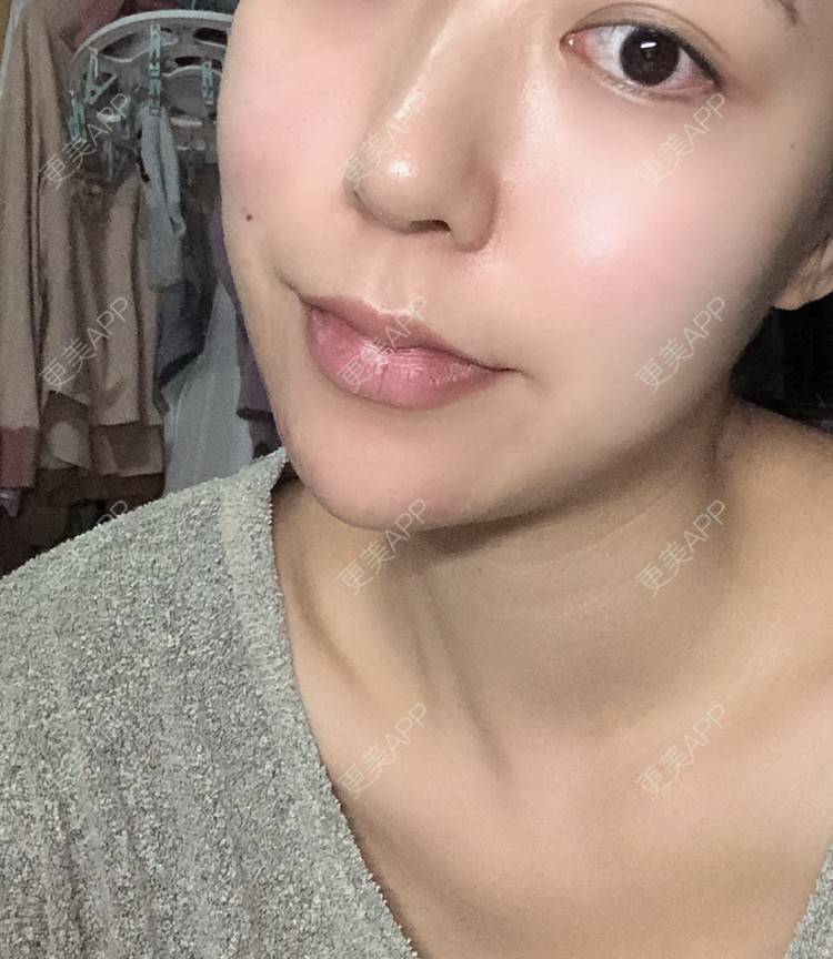 更美 - 薄情人゜缓的M唇成形经验 | M唇成形 | 武汉