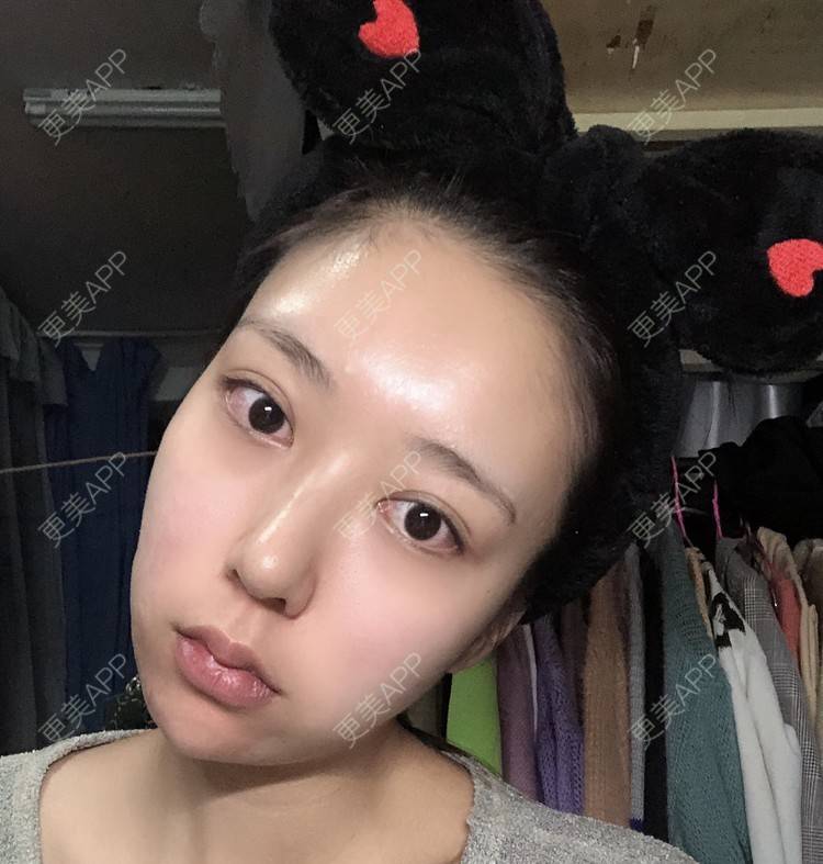 更美 - 薄情人゜缓的M唇成形经验 | M唇成形 | 武汉