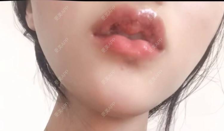 更美 - 薄情人゜缓的M唇成形经验 | M唇成形 | 武汉