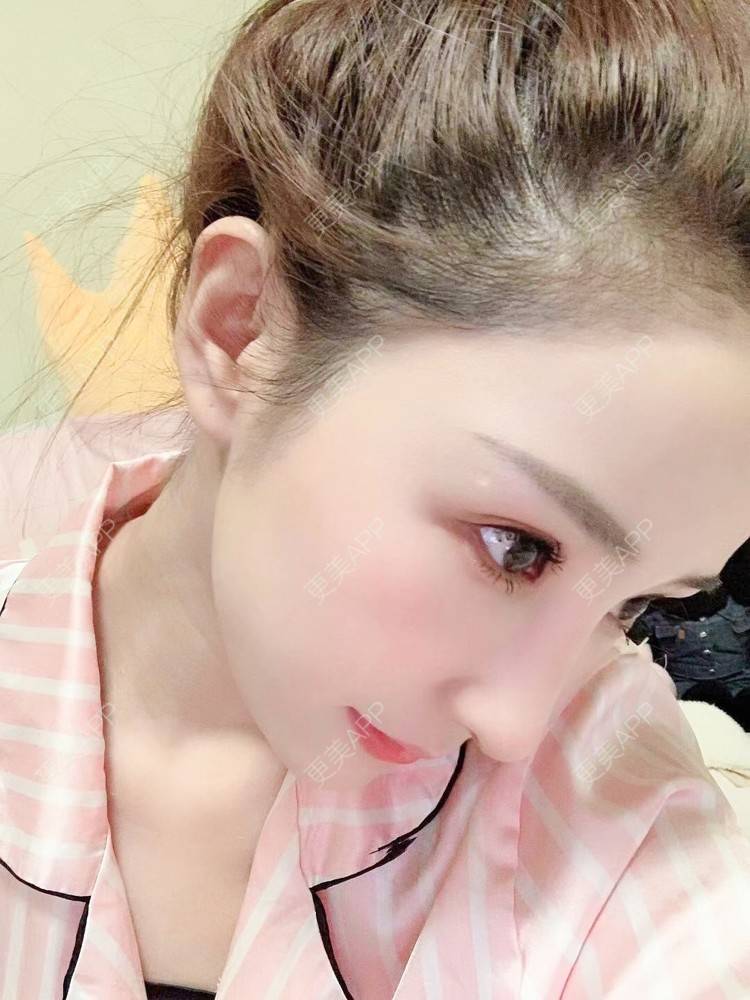 更美 - 更美用户wwGEjehNKy的鼻部多项经验 | 鼻部多项 | 鼻中隔软骨垫鼻头 | 鼻小柱缩短 | 自体软骨垫鼻尖