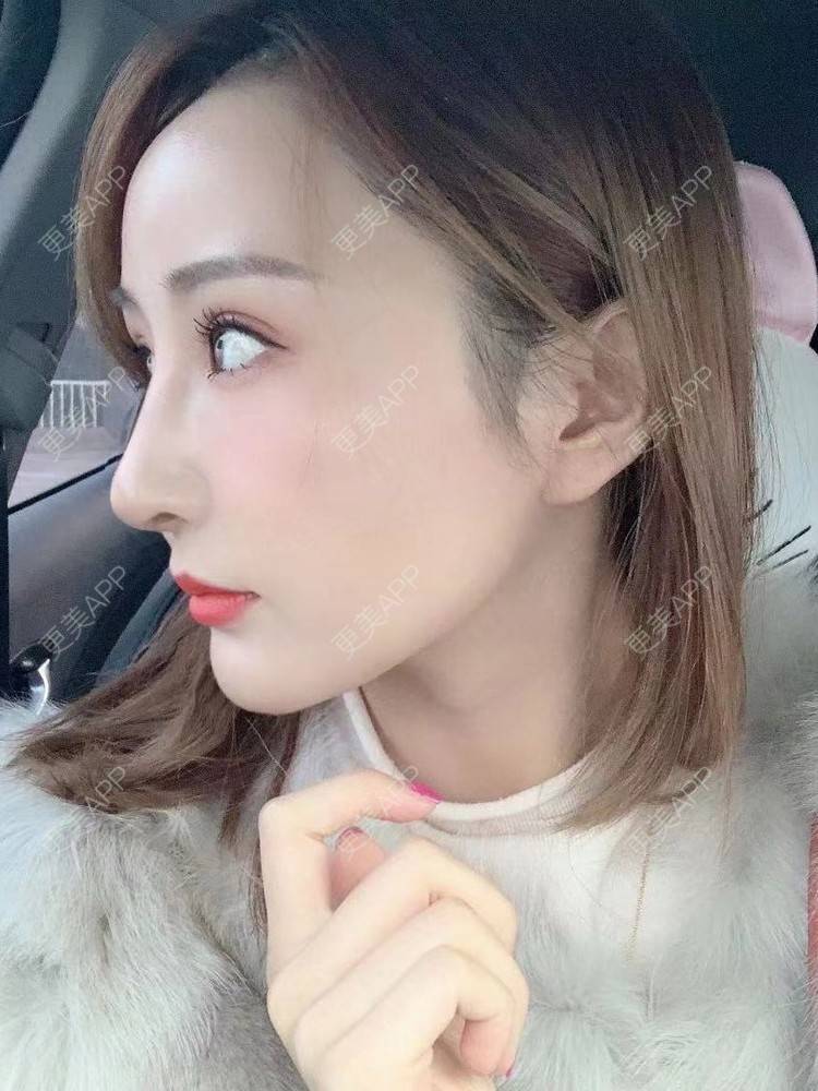 更美 - 更美用户wwGEjehNKy的鼻部多项经验 | 鼻部多项 | 鼻中隔软骨垫鼻头 | 鼻小柱缩短 | 自体软骨垫鼻尖