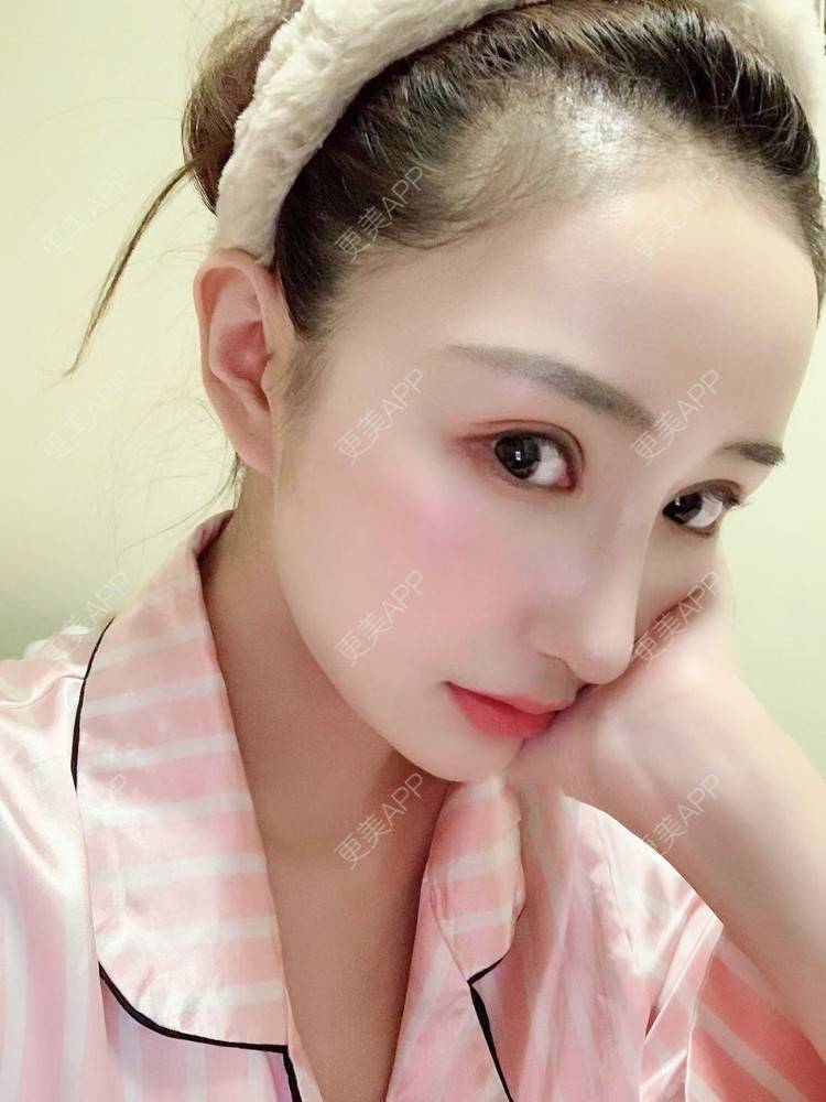 更美 - 更美用户wwGEjehNKy的鼻部多项经验 | 鼻部多项 | 鼻中隔软骨垫鼻头 | 鼻小柱缩短 | 自体软骨垫鼻尖