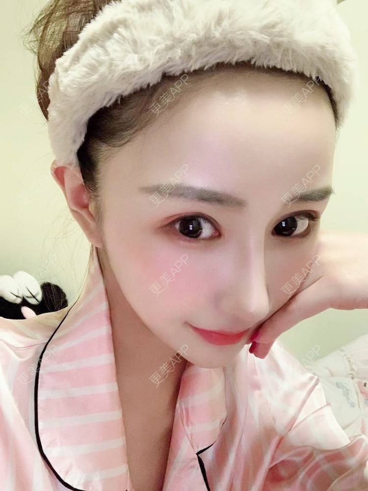 更美 - 更美用户wwGEjehNKy的鼻部多项经验 | 鼻部多项 | 鼻中隔软骨垫鼻头 | 鼻小柱缩短 | 自体软骨垫鼻尖
