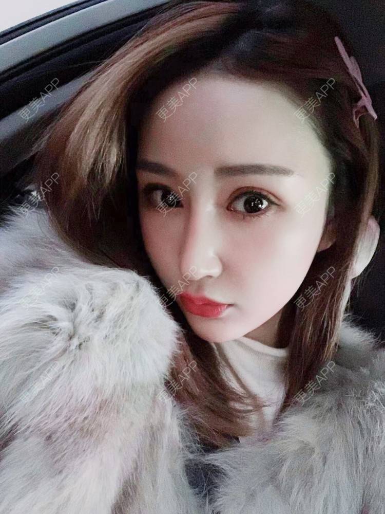 更美 - 更美用户wwGEjehNKy的鼻部多项经验 | 鼻部多项 | 鼻中隔软骨垫鼻头 | 鼻小柱缩短 | 自体软骨垫鼻尖