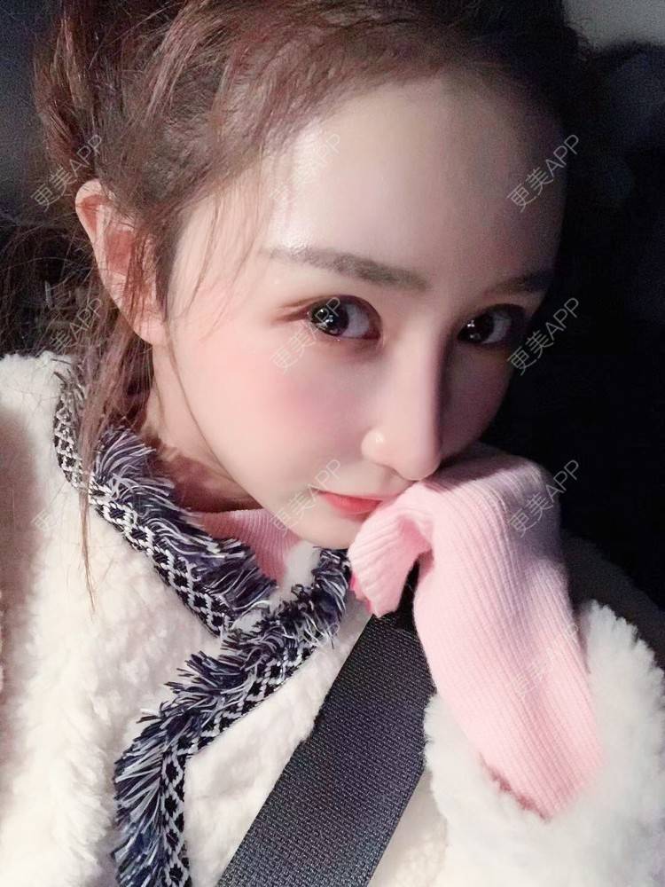 更美 - 更美用户wwGEjehNKy的鼻部多项经验 | 鼻部多项 | 鼻中隔软骨垫鼻头 | 鼻小柱缩短 | 自体软骨垫鼻尖