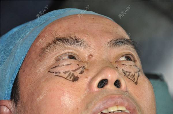 更美 - 更美用户IG0lQLfUjW的外切去眼袋经验 | 杭州 | 外切去眼袋