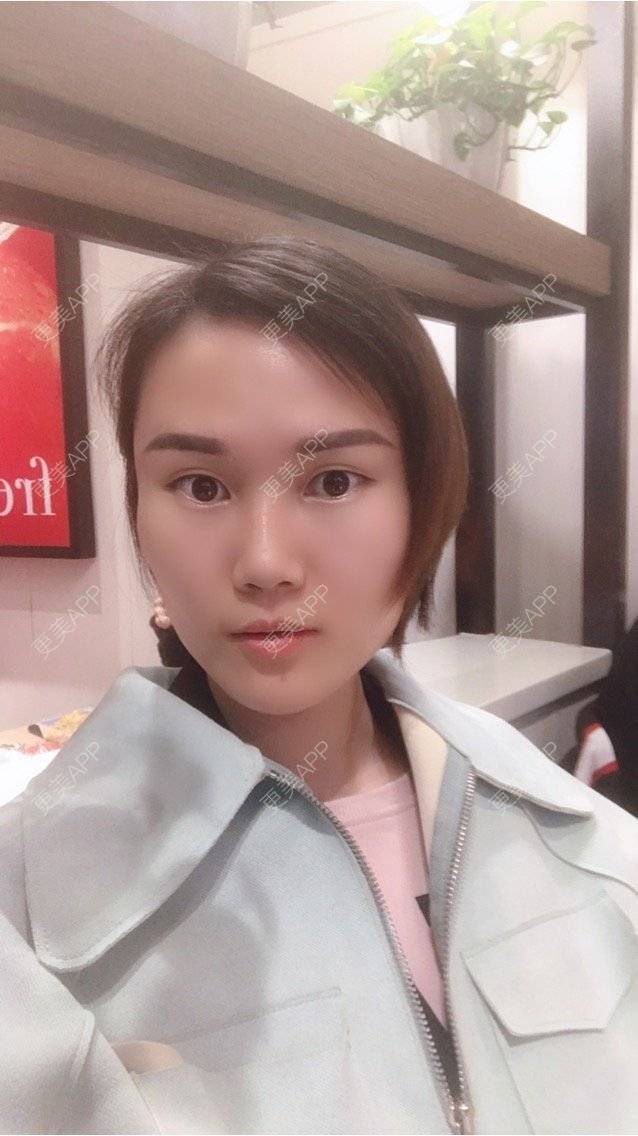 更美 - 安迪🌷的玻尿酸面颊经验 | 上海 | 玻尿酸面颊