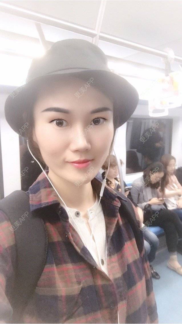更美 - 安迪🌷的玻尿酸面颊经验 | 上海 | 玻尿酸面颊